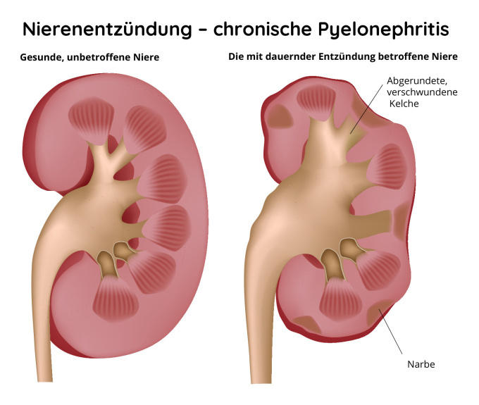 Unterschied zwischen der gesunden und kranken Niere