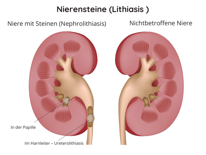 Nierenstein in Niere und Harnleiter