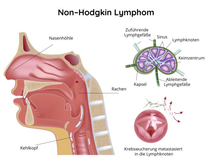 Krebswucherung der Lymphknoten