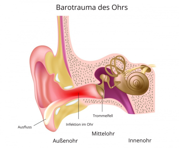 Schematische Darstellung des Ohrbarotraumas