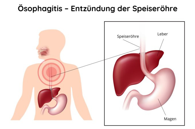 Ösophagitis - Speiseröhrenentzündung