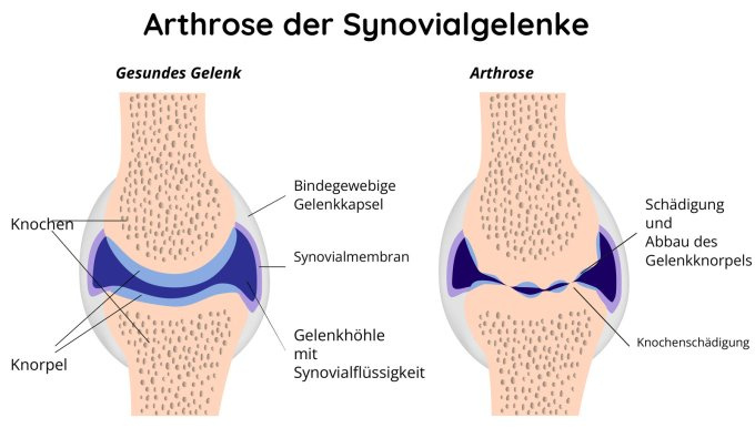 Gesundes Gelenk und Gelenk mit Osteoarthritis