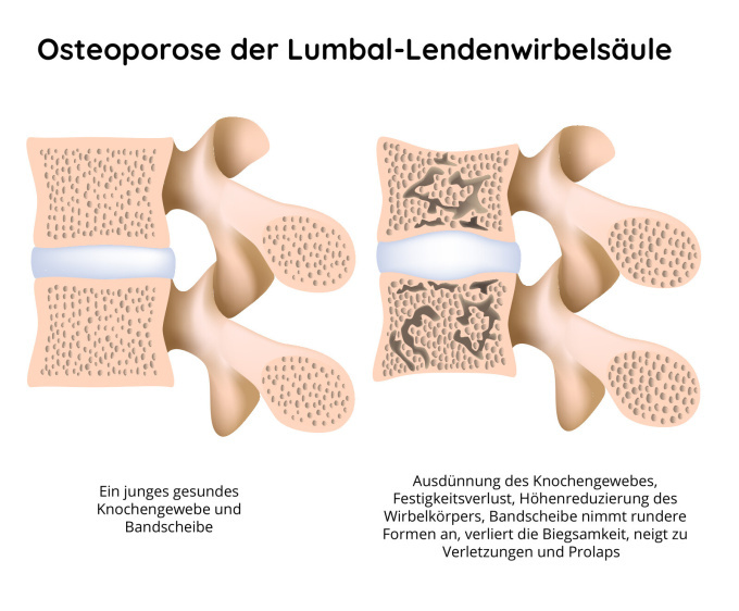 Osteoporose der Lendenwirbelsäule