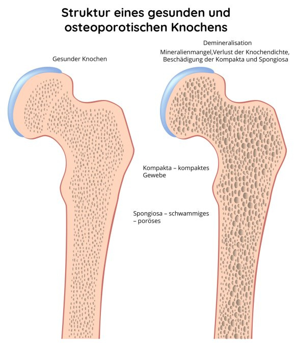 Struktur des gesunden und osteoporotischen Knochens