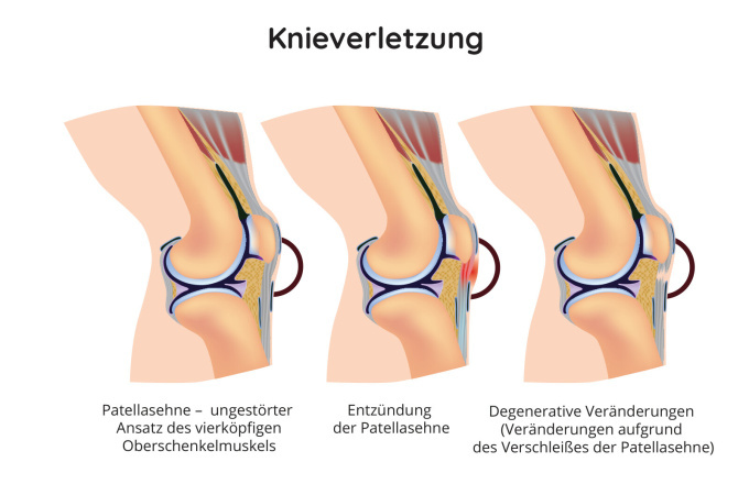 Knieverletzung