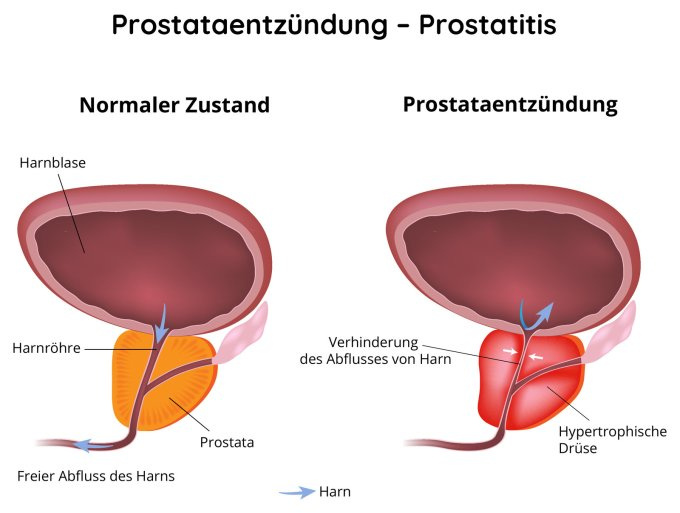 Prostatitis - eine unangenehme männliche Krankheit
