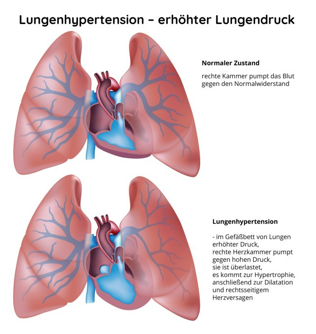 Lungenhypertension - erhöhter Lungendruck