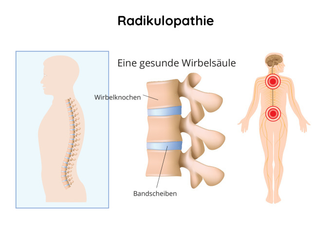 Radikulopathie