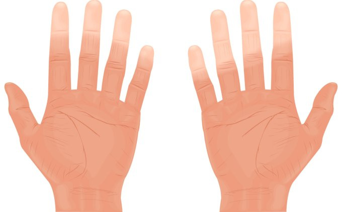 Raynaud-Syndrom