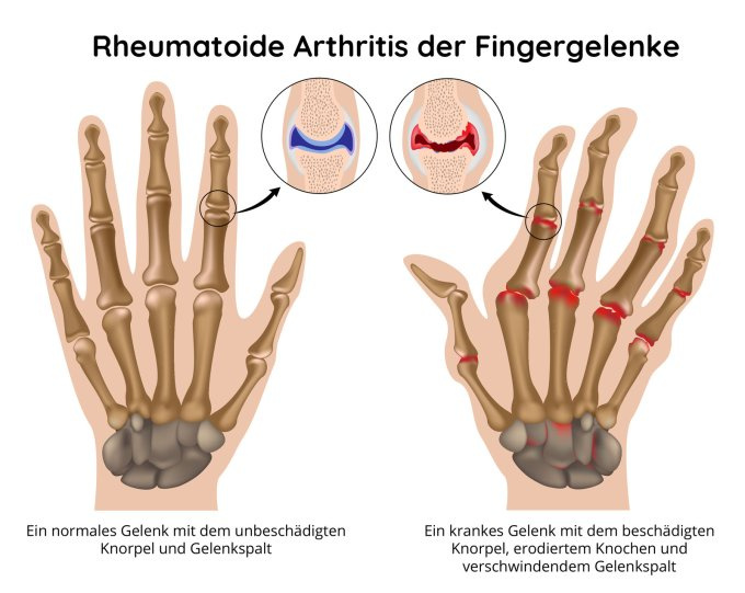 Rheumatoide Arthritis
