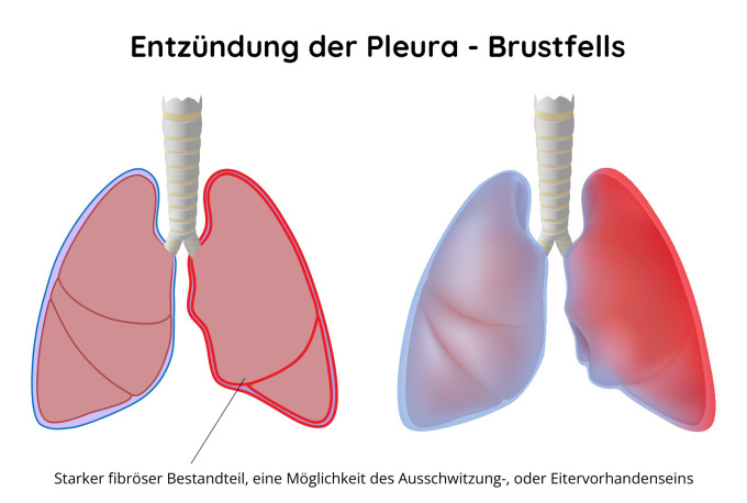 Entzündung der Pleura  - Brustfells