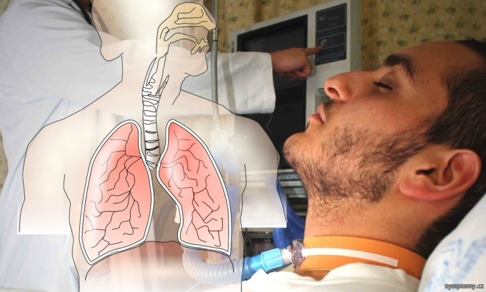SARS - das Schwere Akute Respiratorische Syndrom