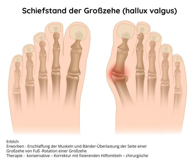 Schiefstand der Großzehe - Hallux valgus