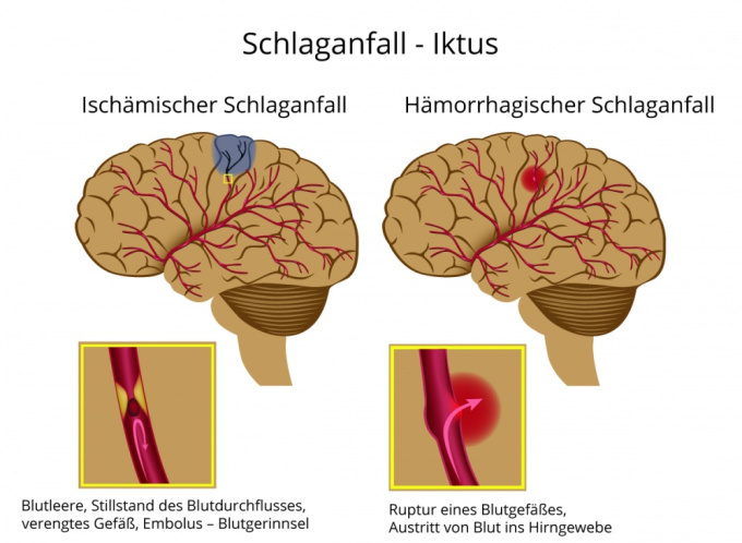 Schlaganfall - Iktus
