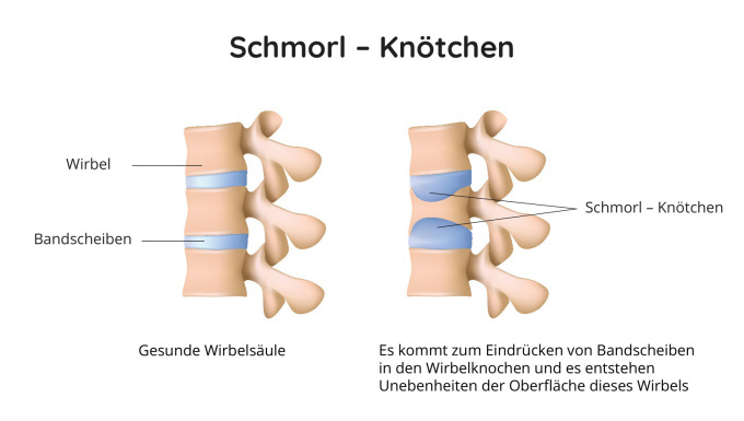 Schmorl - Knötchen auf der Wirbelsäule
