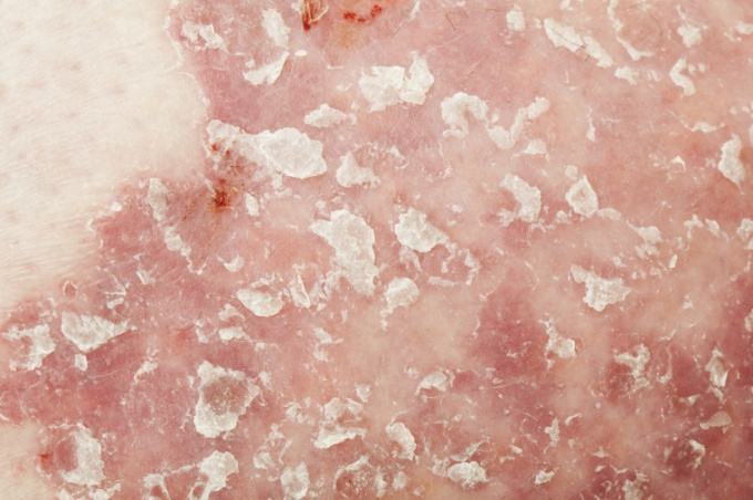 Schuppenflechte (Psoriasis vulgaris)