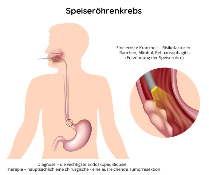 Speiseröhrenkrebs