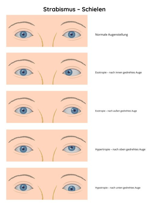 Strabismus – Schielen