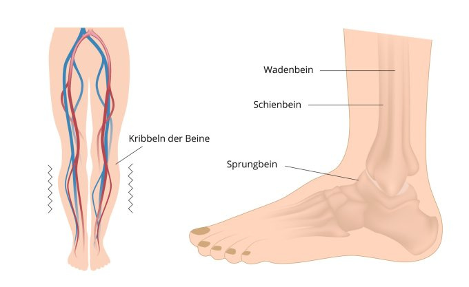 Syndrom der ruhelosen Beine