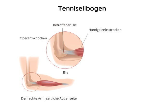 Darstellung des Tennisellenbogens