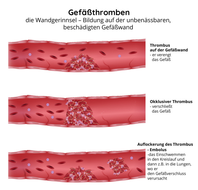 Gefäßthromben