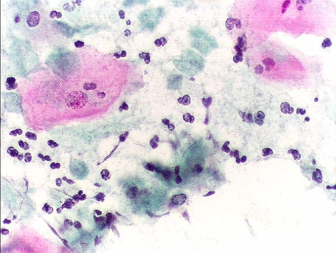 Trichomoniasis