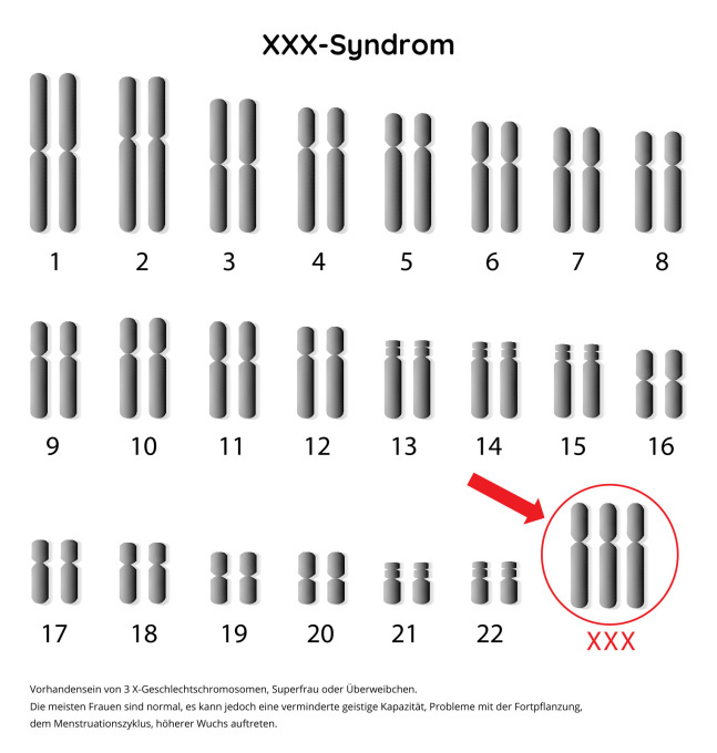 XXX-Syndrom