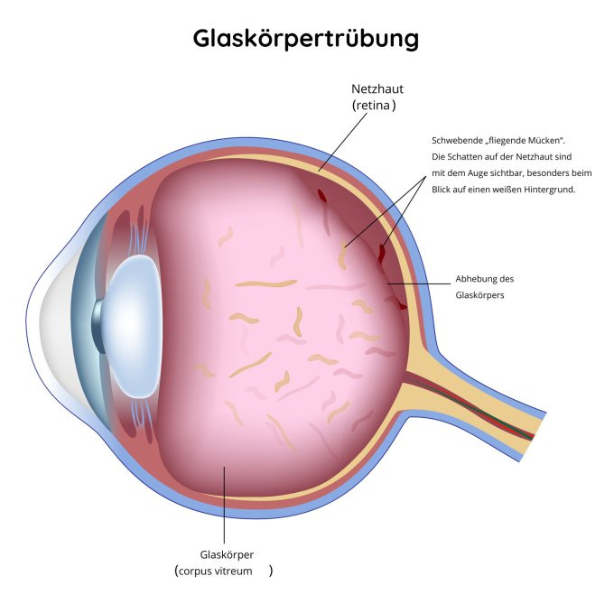 Glaskörpertrübung