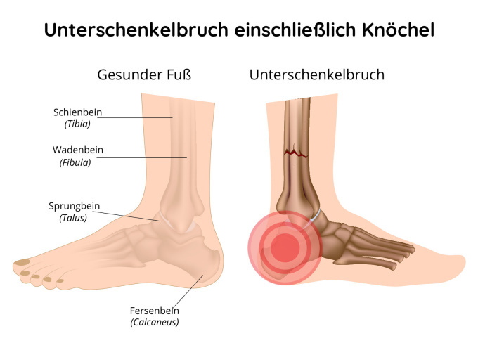 Unterschenkelbruch einschließlich Knöchels