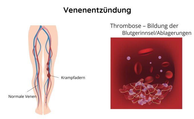 Venenentzündung - Bildung der Blutgerinnsel