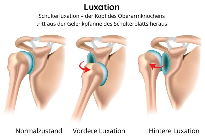 Verrenkung - Dislokation der Schulter