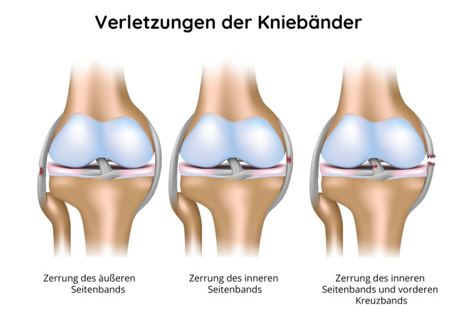 Verletzungen der Kniebänder