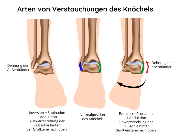 Arten der Knöchelverstauchung