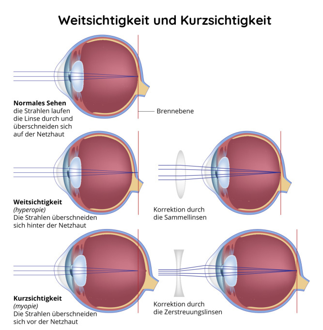 Schematische Darstellung der Weitsichtigkeit und Kurzsichtigkeit