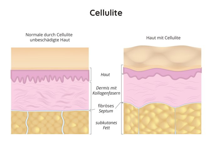 Haut mit Zellulitis