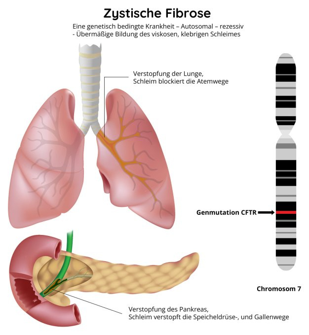 Zystische Fibrose
