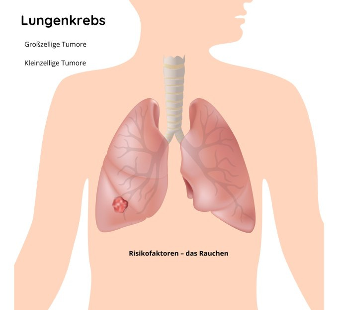 Lungenkrebs - die häufigste Art von Krebs