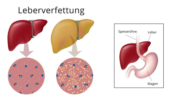 Vergrößerte Leber durch ihre Verfettung