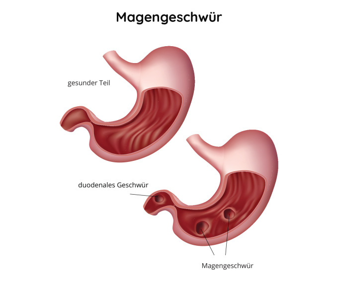 Magengeschwür