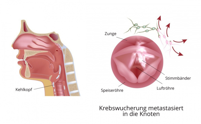 Krebswucherung metastasiert in die Lymphknoten