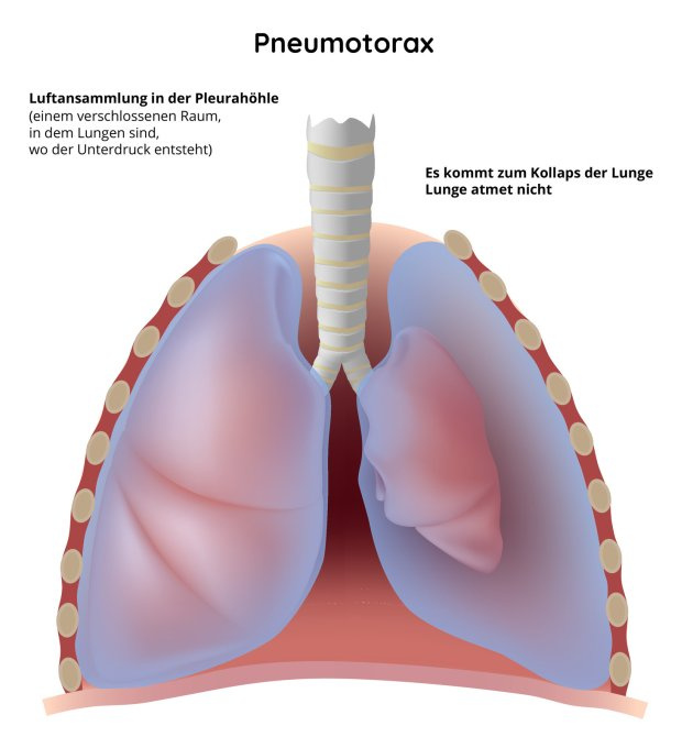 Pneumothorax - Luftansammlung in Lungen