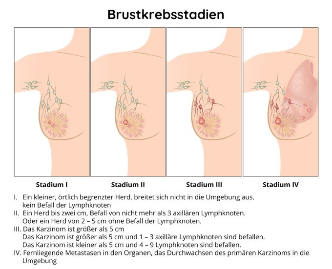 Vier Brustkrebsstadien