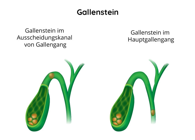 Gallensteine