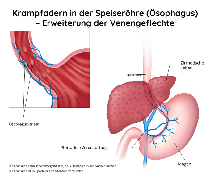 Krampfadern in der Speiseröhre (Ösophagus)  – Erweiterung der Venengeflechte