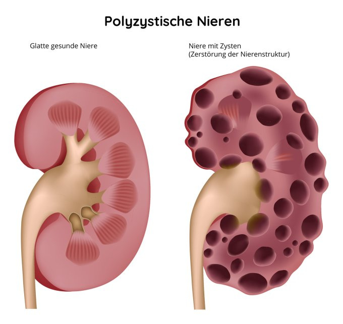 Polyzystische Nieren