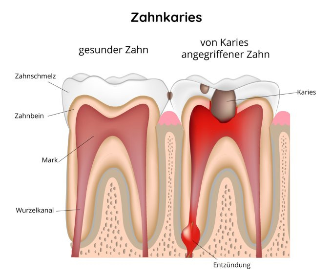 Ein gesunder Zahn und Zahn mit dem Karies