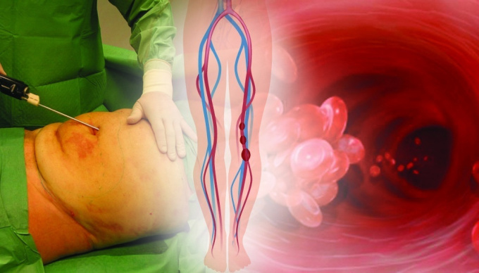 Liposuktion