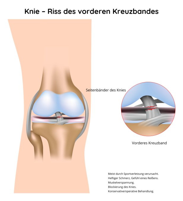 Knie – Riss des vorderen Kreuzbandes