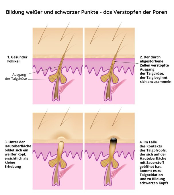 Bildung weißer und schwarzer Punkte
