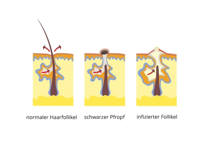 Acne vulgaris.jpg